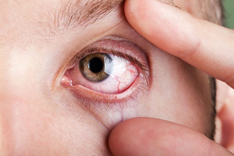 distinguir-ojo-seco-alergia.jpg